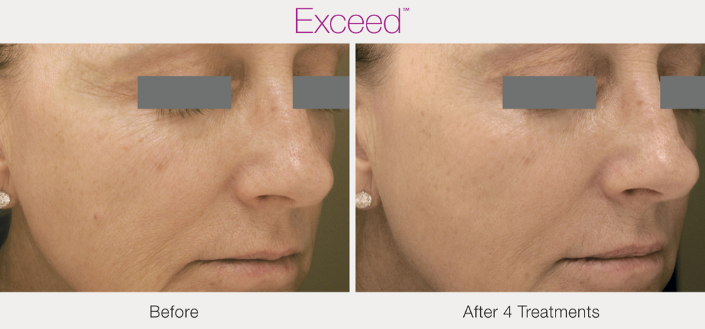 Skin microneedling before and after result